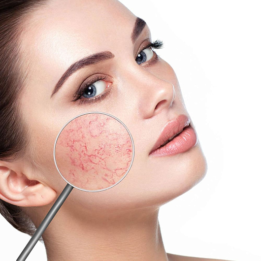 Reviderm Couperose therapy cream